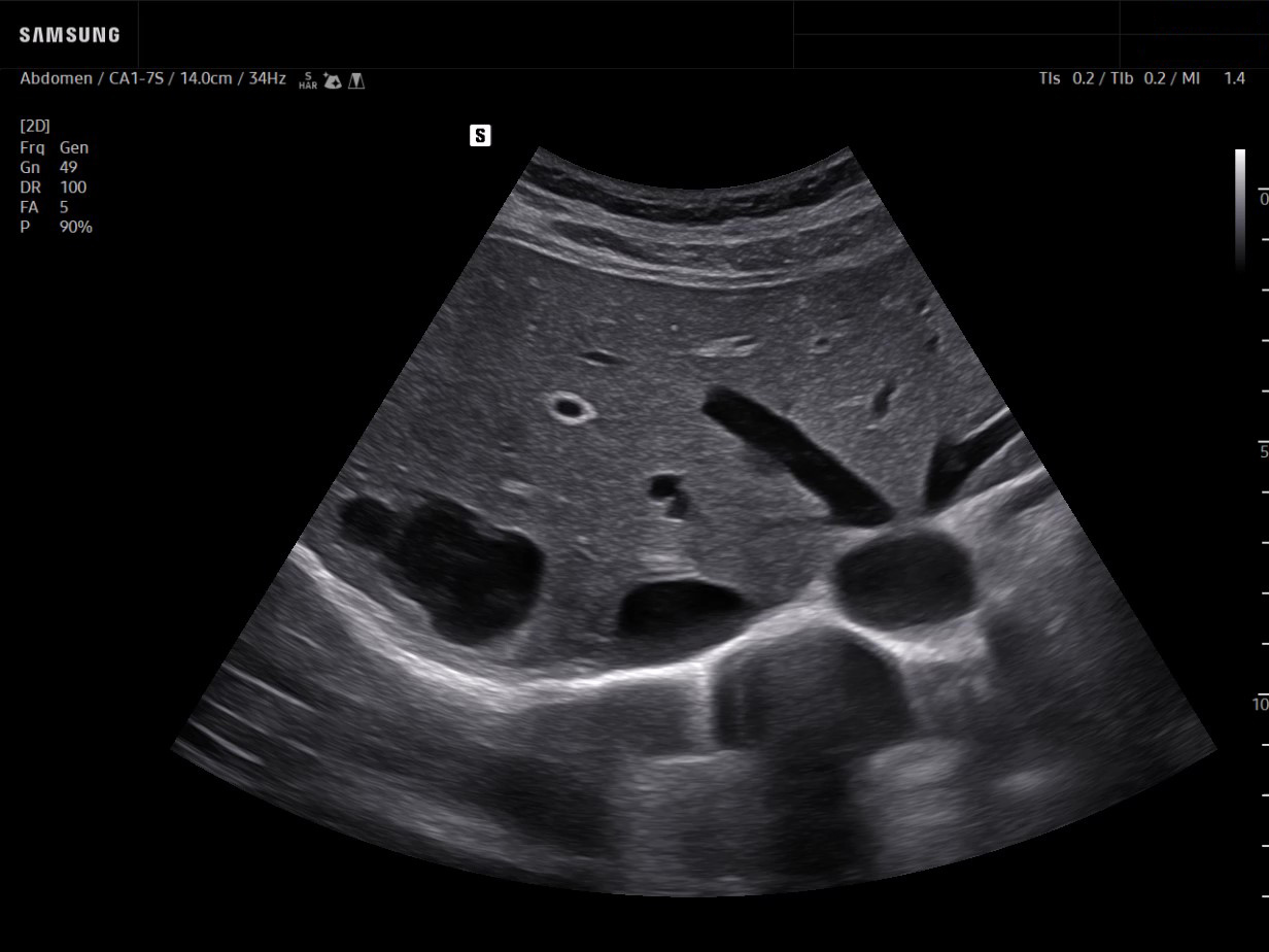 Liver cyst ultrasound showing multiple cystic lesions within the liver parenchyma