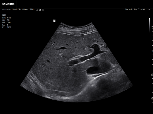 Liver ultrasound showing transverse view with bifurcation of the portal vein