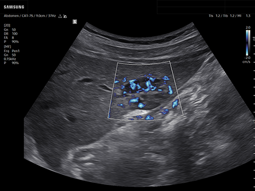 https://global.samsungsuite.com/image/liver-hemangioma-using-mv-flow-with-lumiflow/