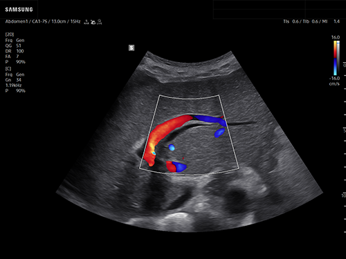 Liver cirrhosis ultrasound showing hepatic blood flow patterns using color Doppler imaging