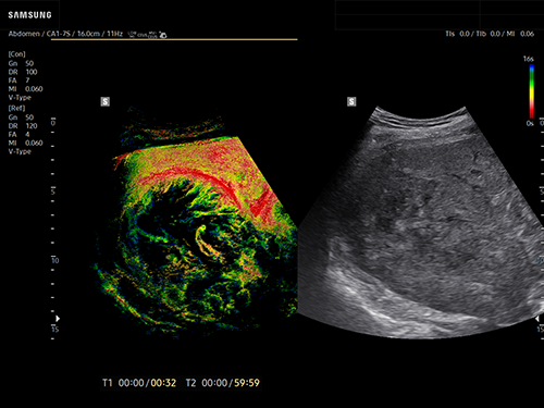 Ultrasound imaging on liver cancer ultrasound showing a large hepatic tumor evaluated with contrast-enhanced ultrasound using CEUS+ and TOA