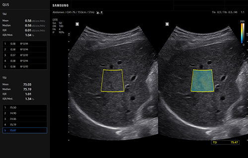 Intercostal liver ultrasound with region of interest outlined on grayscale imaging