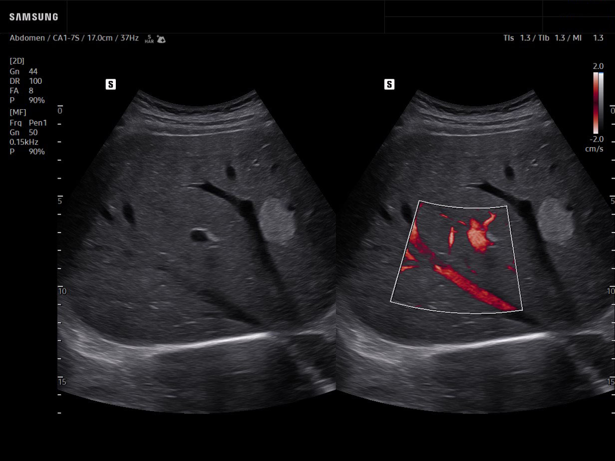 Liver ultrasound showing blood flow in a hepatic hemangioma with MV-Flow