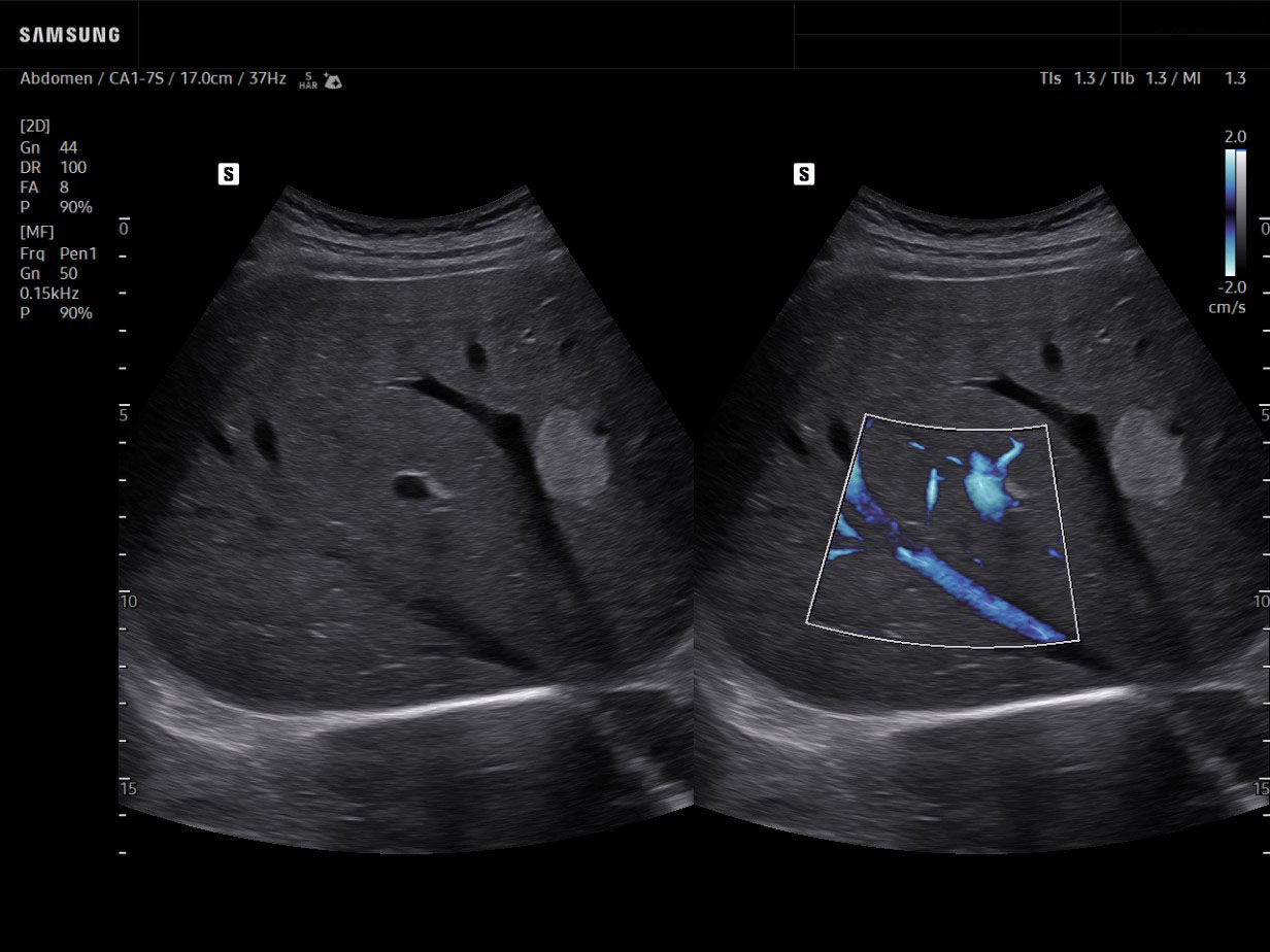 Liver ultrasound showing blood flow in a hepatic hemangioma with MV-Flow and LumiFlow in blue tone