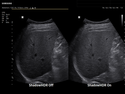 Liver ultrasound showing intercostal dual mode comparison with ShadowHDR on and off