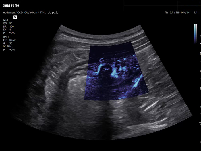 Diverticulitis ultrasound showing bowel wall inflammation with MV-Flow blood flow imaging