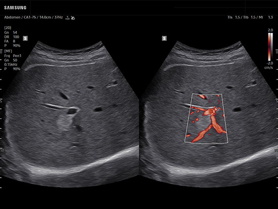 Liver hemangioma ultrasound showing dual live imaging with MV-Flow™