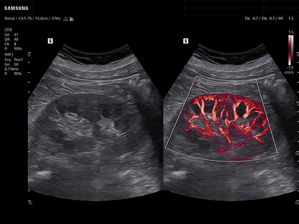 Kidney ultrasound showing renal blood flow with color MV-Flow in dual layout