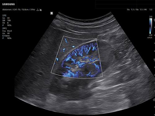 Kidney ultrasound showing renal blood flow using color-mode MV-Flow