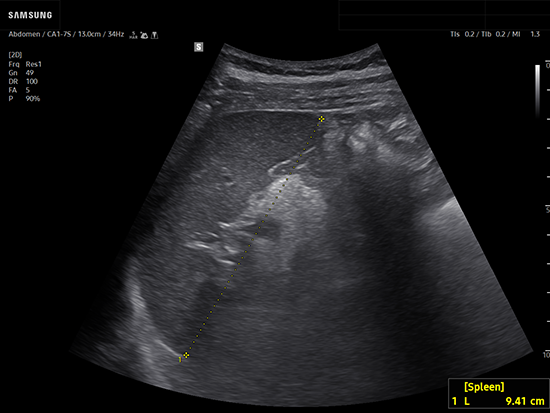Spleen ultrasound showing automated splenic length measurement using AbdomenAssist