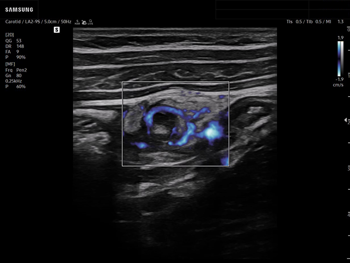 Bowel ultrasound showing vascularity with color-mode MV-Flow™ imaging