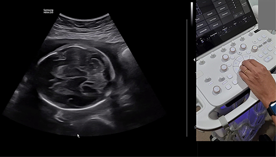 Demo on ultrasound knobology optimizing HERA Z20 settings for improved image quality